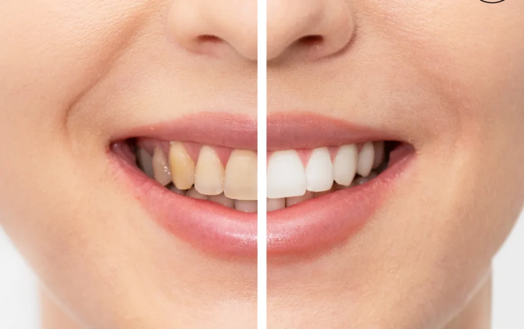 Before and after teeth whitening results at Dorri's Dental in Boynton Beach, FL — stained teeth transformed to bright white smile