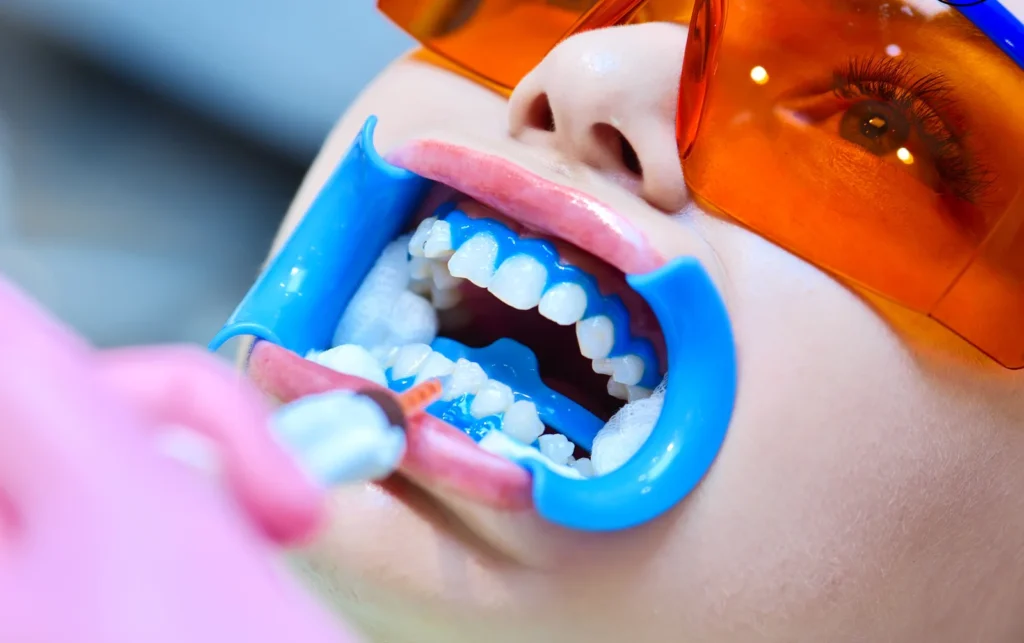 Professional Whitening vs. Store-Bought Kits — There's No Comparison
