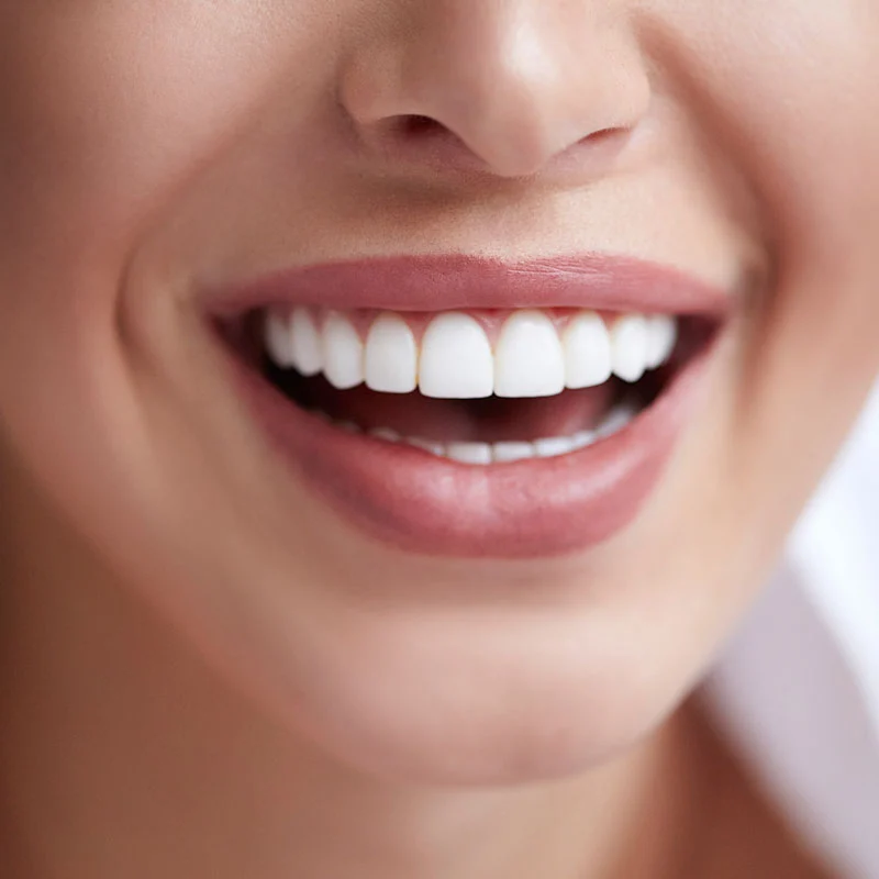 Bright smile with dental veneers at Dorri's Dental in Boynton Beach, FL