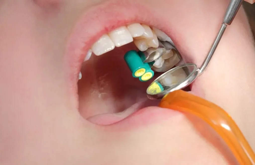 Dental fillings and sealants procedure close-up at Dorri's Dental, Boynton Beach FL — cavity treatment with dental tools