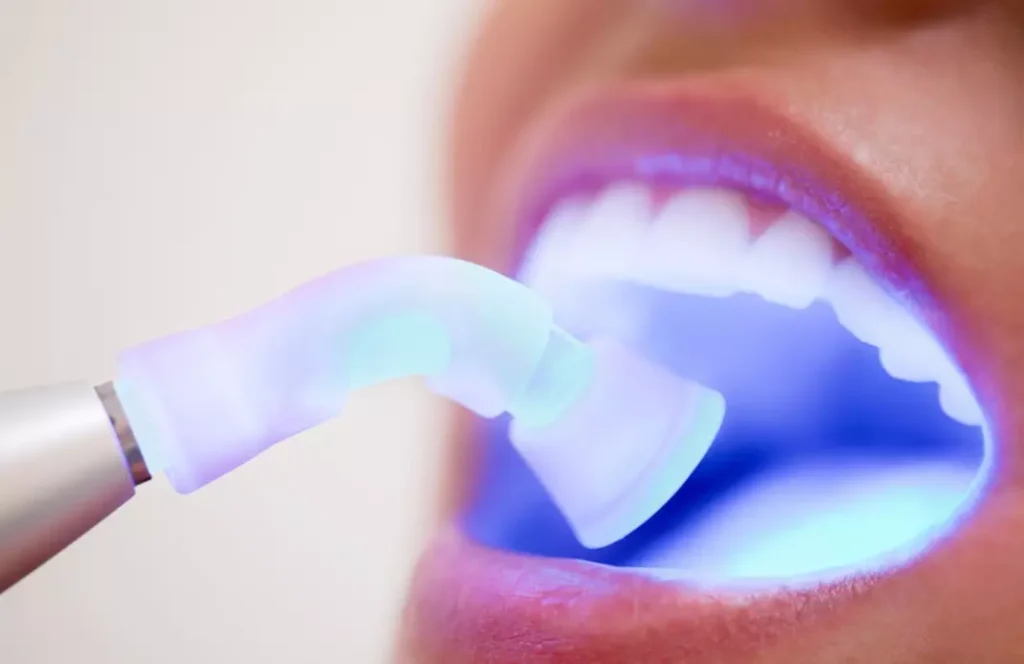 Dental sealant tray being applied to teeth at Dorri's Dental, Boynton Beach FL — dental fillings and sealants cavity prevention treatment