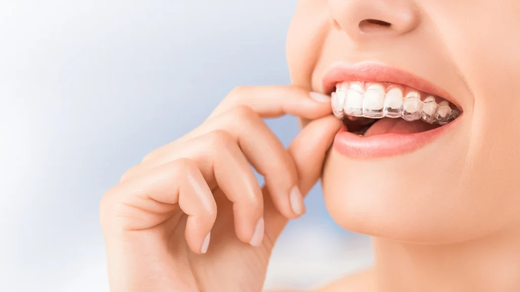 Patient removing Invisalign clear aligners to show straighter teeth and improved smile alignment