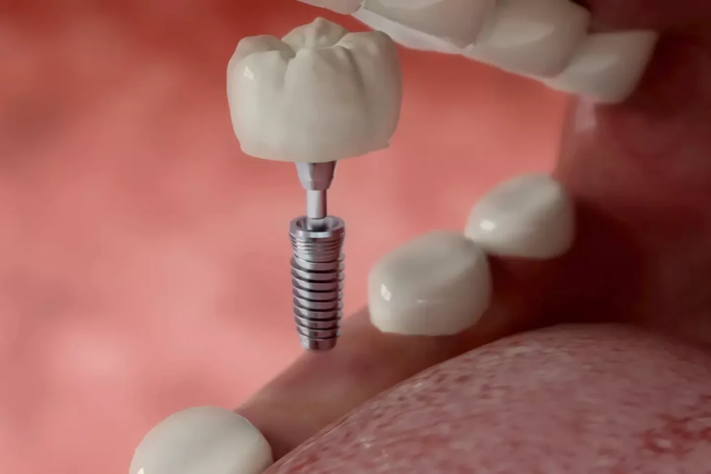 Illustration of a dental bone grafting procedure preparing the jawbone for a dental implant