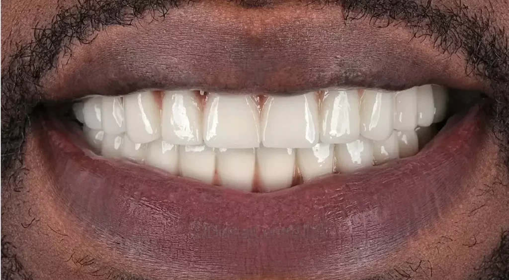 after-full-mouth-all-on-4-dental-implants-dorris-dental-case-1