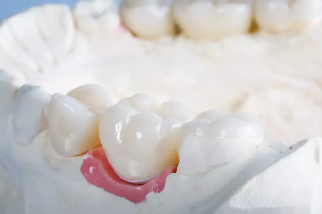 Close-up of a dental crown fitted on a tooth model at Dorri's Dental in Boynton Beach, FL