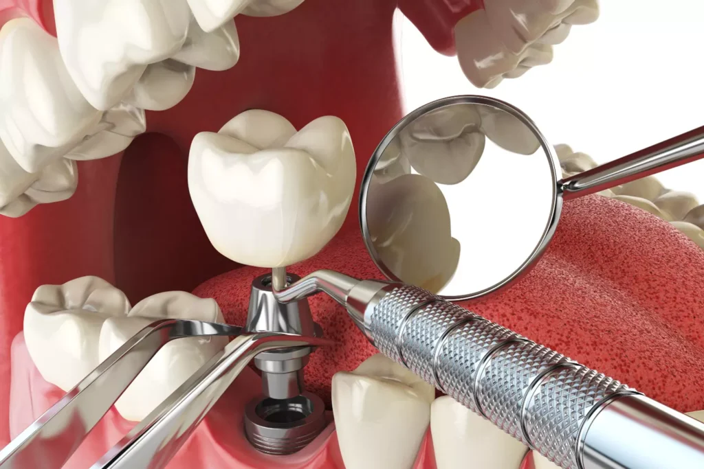 Close-up illustration of a dental implant procedure with a crown being placed onto a titanium implant post