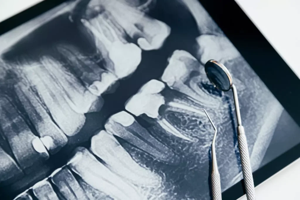 Comprehensive dental exams & X-rays at Dorri's Dental, Boynton Beach FL — full mouth X-ray with dental mirror tool