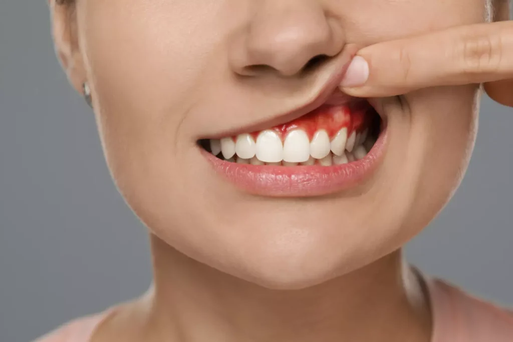 Woman showing inflamed bleeding gums — signs of gum disease treated with scaling, root planing, and periodontal surgery at Dorri's Dental, Boynton Beach FL