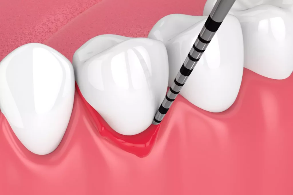 3D illustration of gum disease periodontal probing and gum treatment at Dorri's Dental, Boynton Beach FL