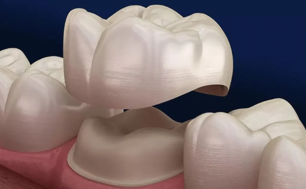 Illustration of a dental crown being placed over a tooth at Dorri's Dental in Boynton Beach, FL