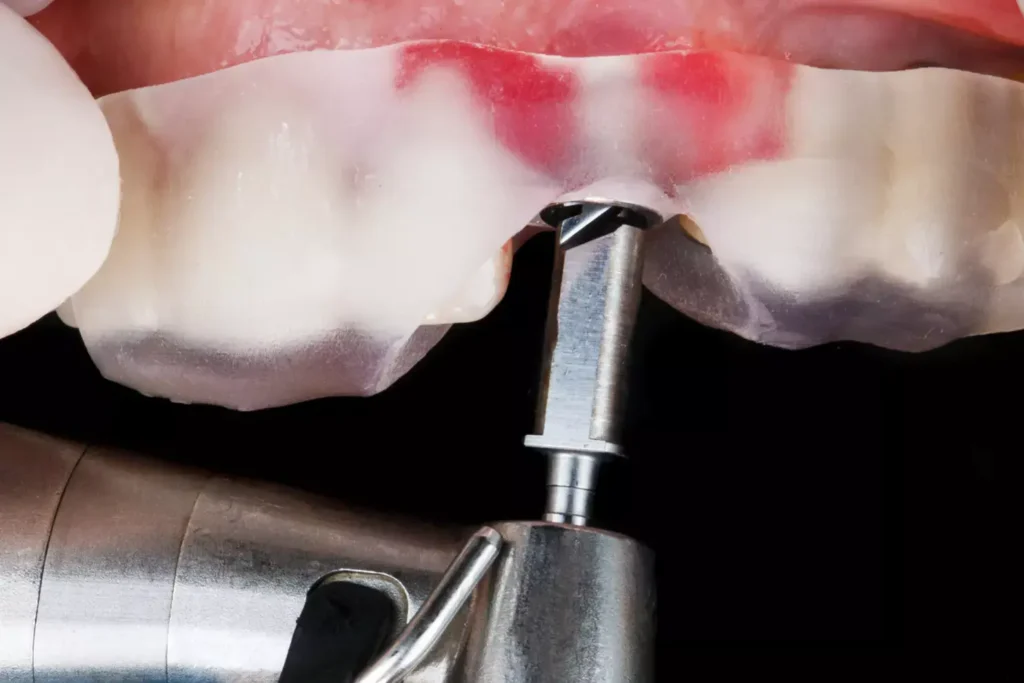Illustration of a dental bone graft procedure to restore jawbone at Dorri's Dental in Boynton Beach, FL