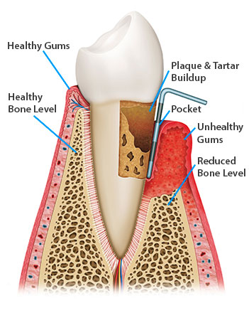 periodontal-disease