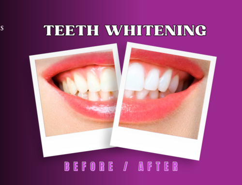 Teeth Whitening in Boynton Beach, FL