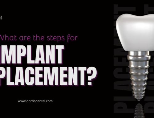 Implant placement in Boynton Beach, FL