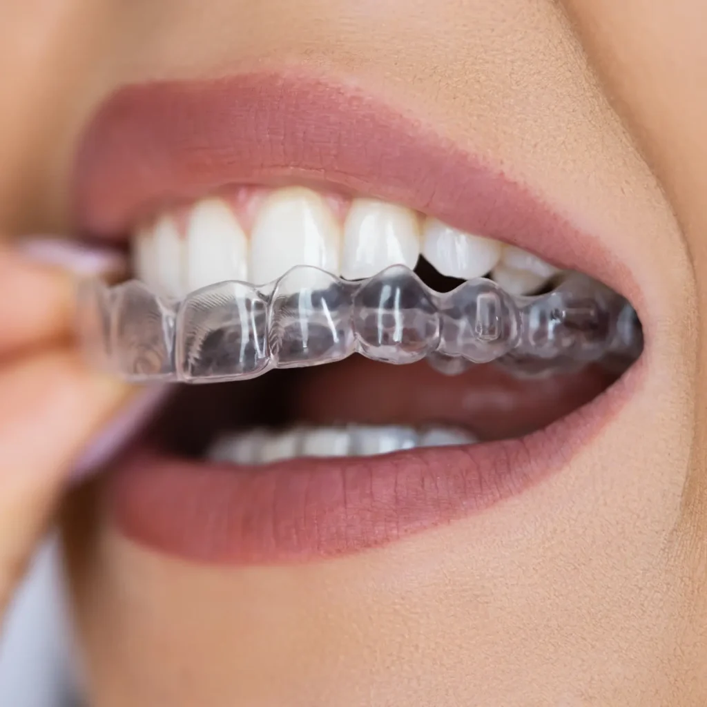 Patient placing a custom-fit night guard over their teeth at Dorri's Dental in Boynton Beach, FL