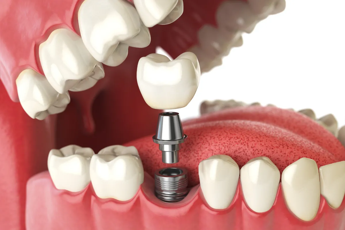Dentures compared to natural teeth