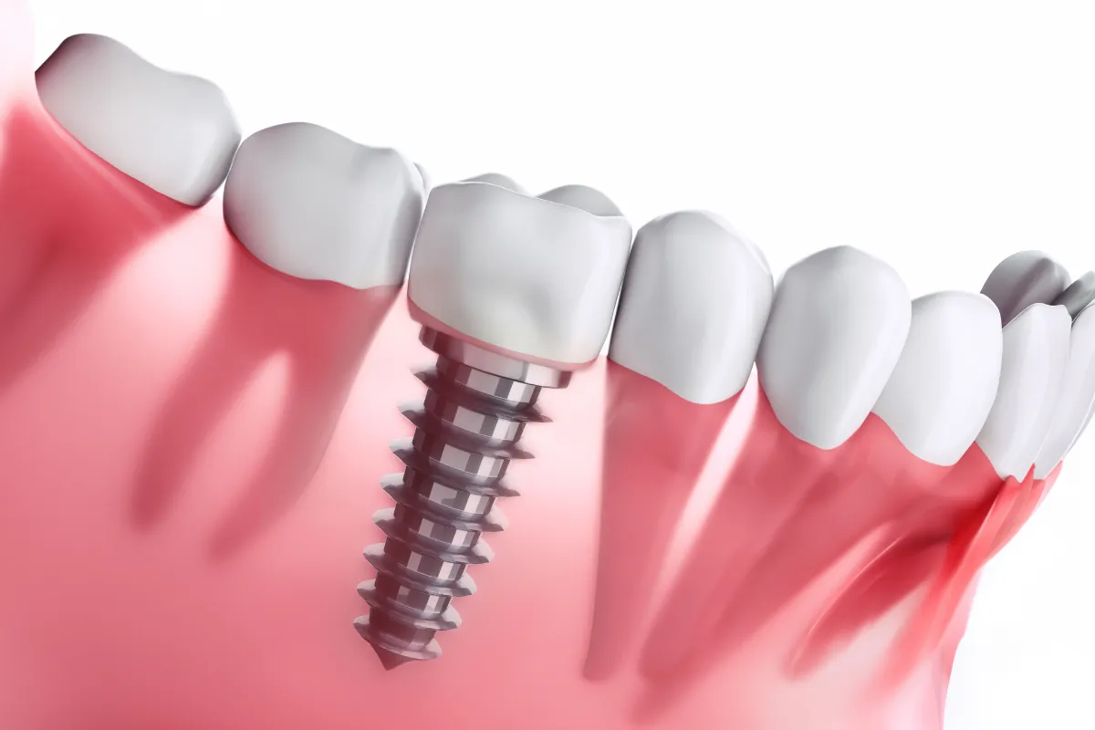 All on 4 dental implant
