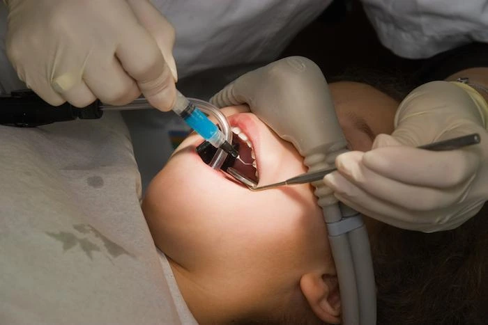 Dentist performing root canal procedure using nitrous oxide sedation in Boynton Beach
