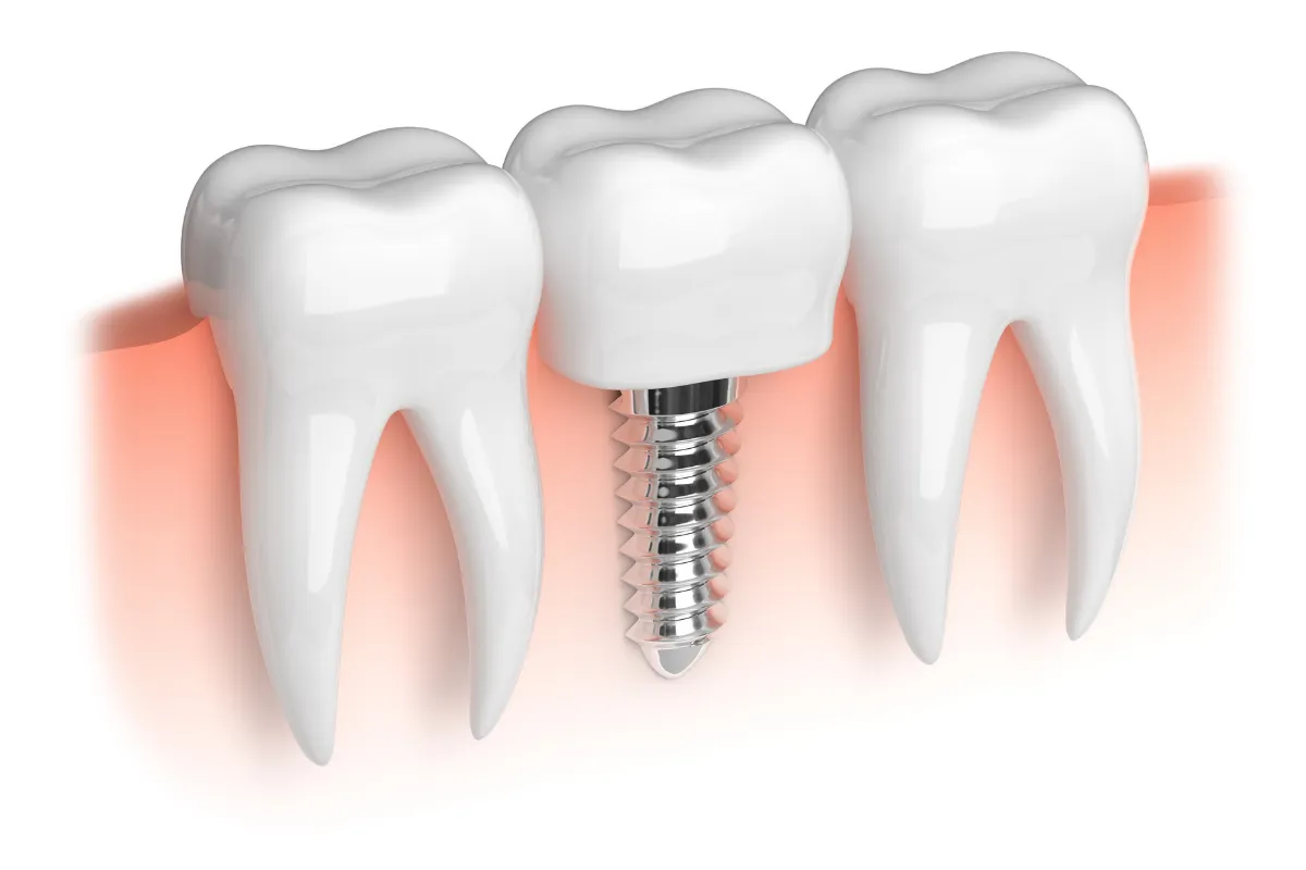 Doctor installing dental implant