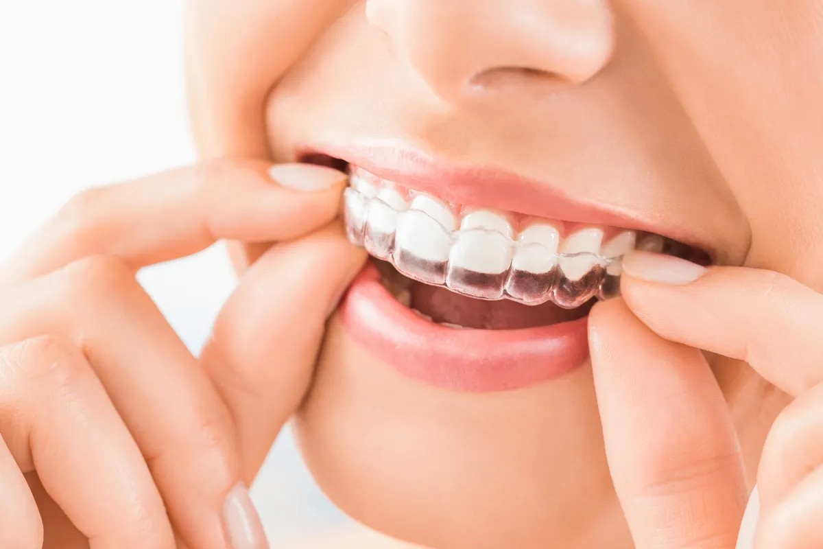 Close up of a person removing clear aligners