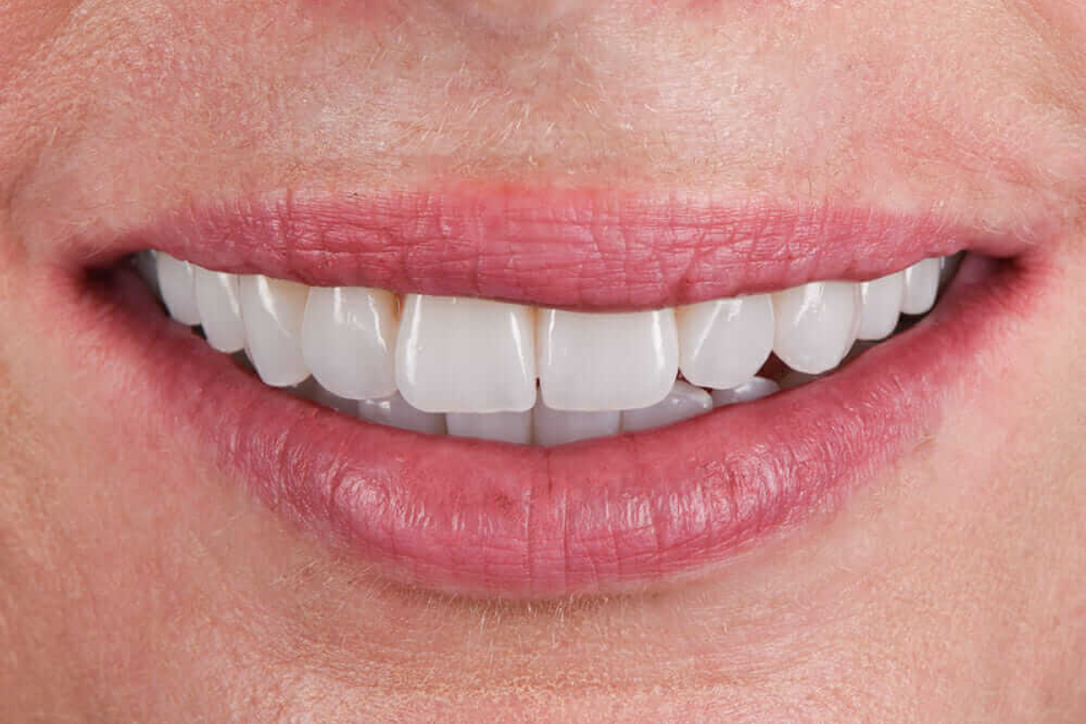 Invisalign alternative