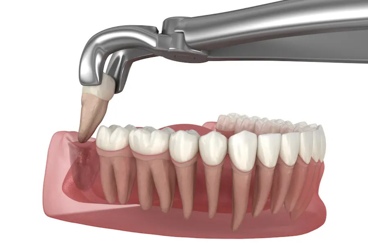 Wisdom teeth extraction process
