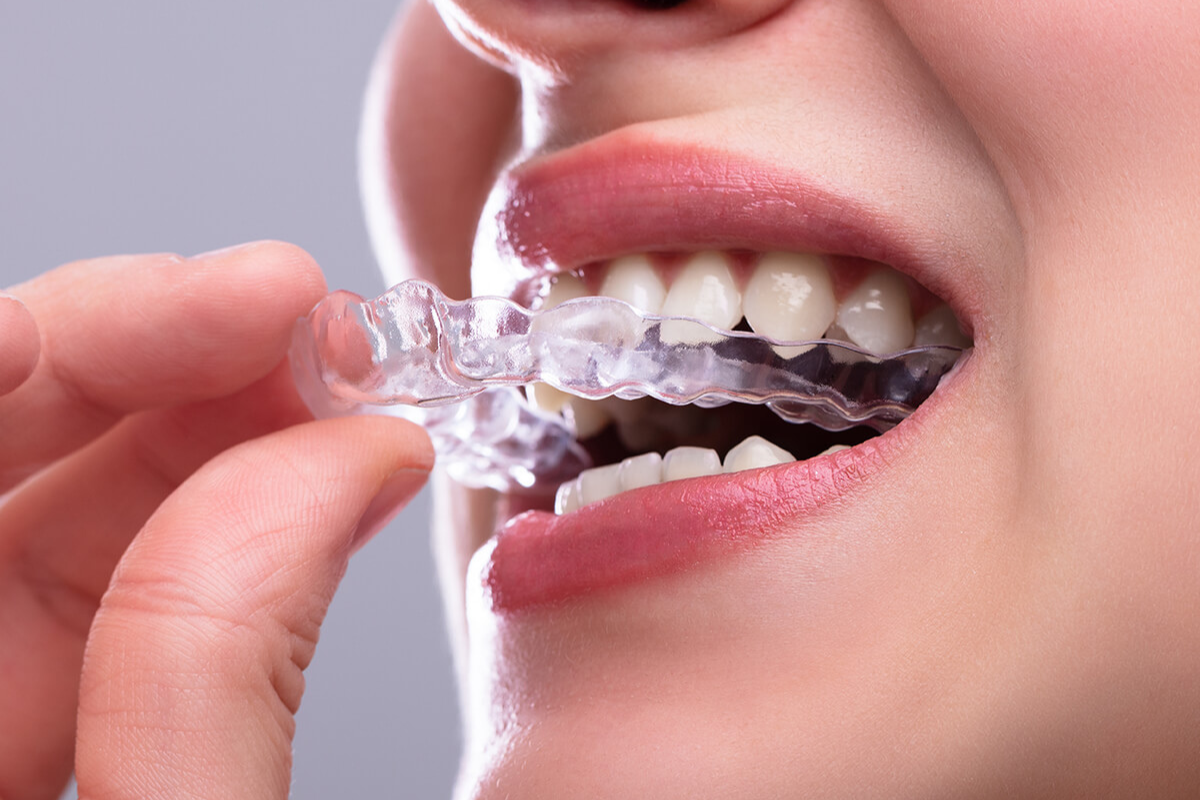 Discreet Clear Aligners