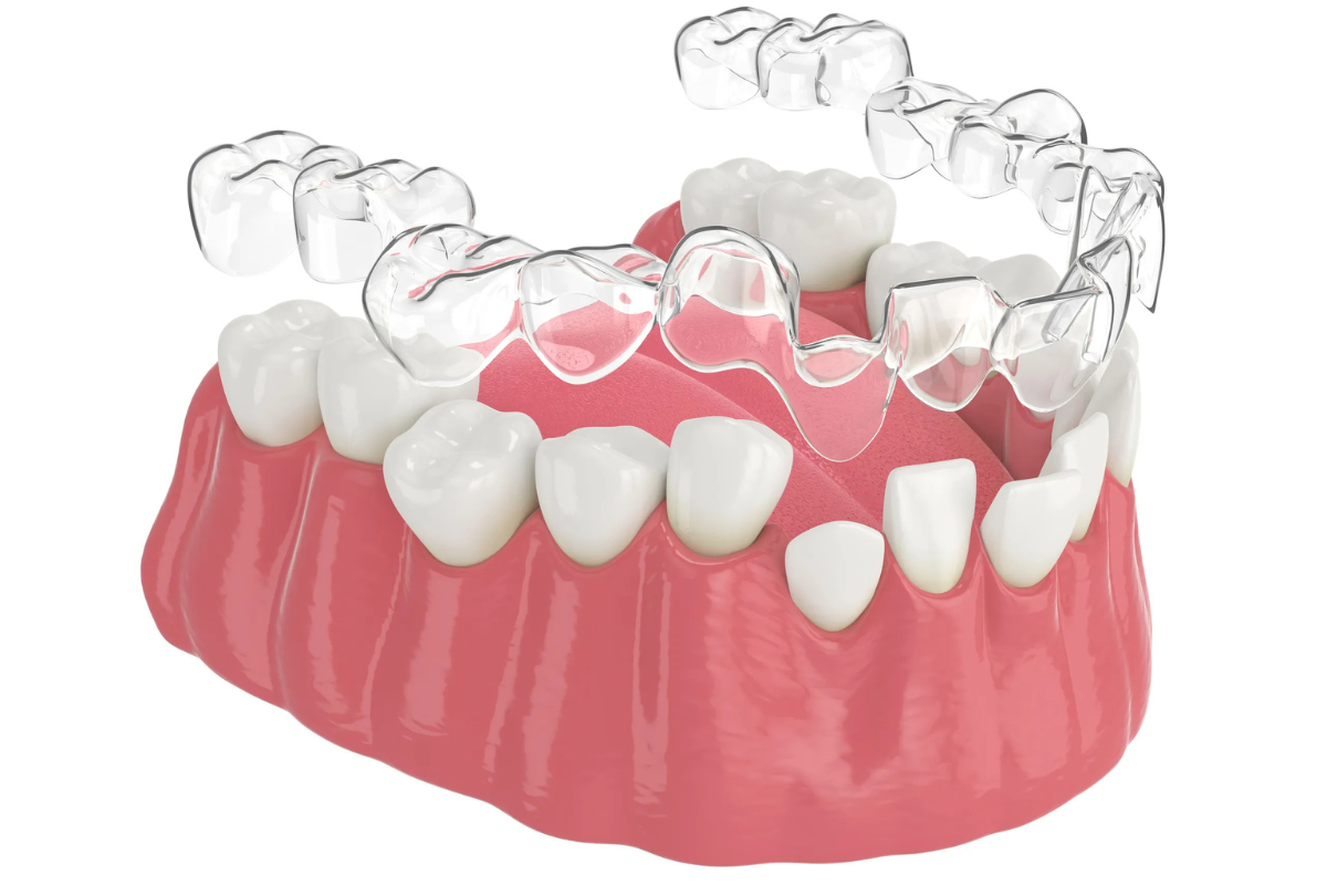 Traditional Braces