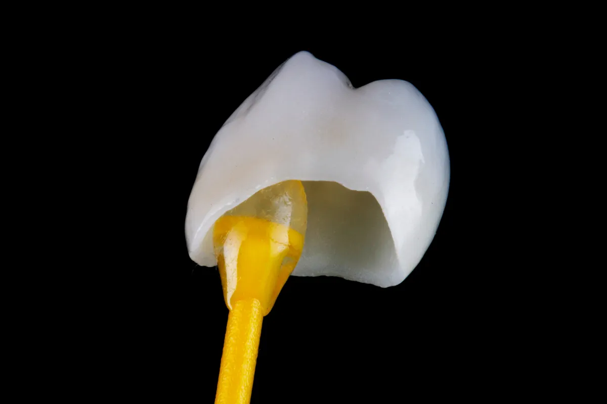 Damaged tooth being assessed for a dental crown