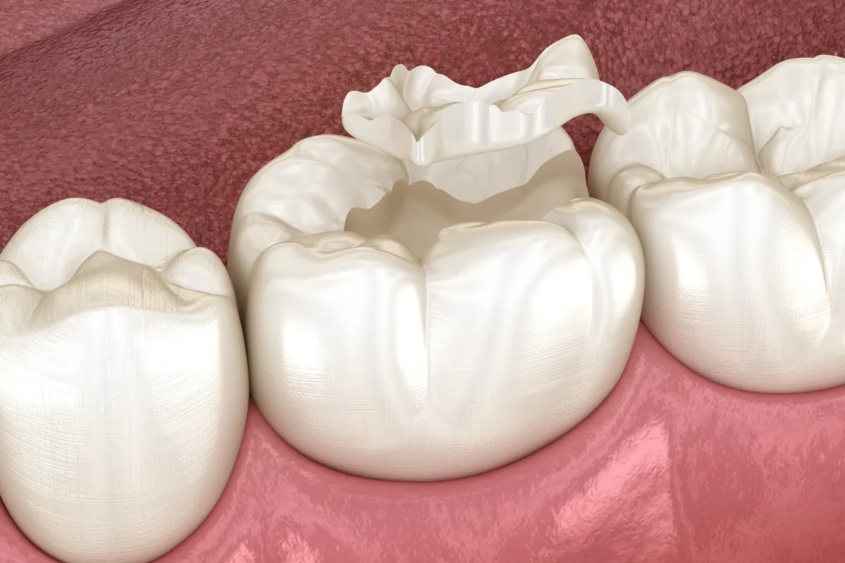 Dental Sealants Application