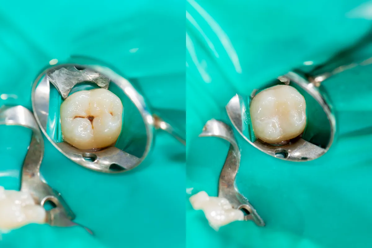 Different Types of Dental Fillings