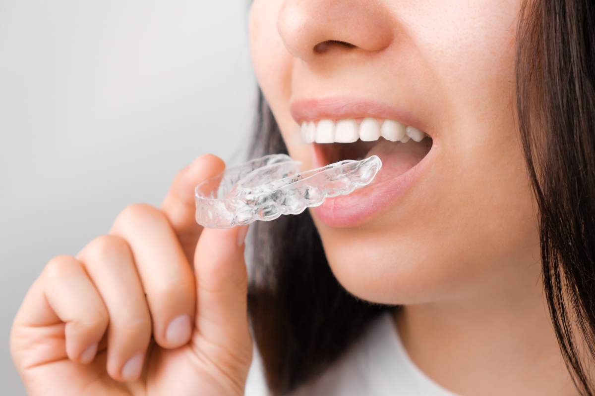 Clear Aligners