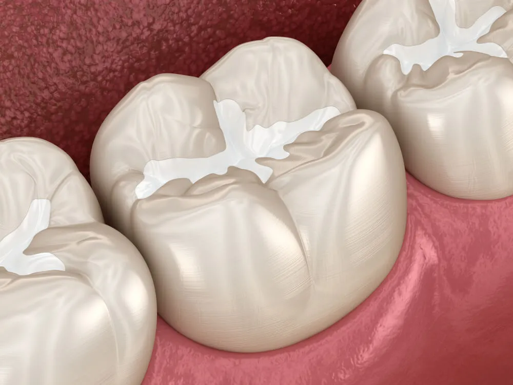 Illustration of composite fillings on molars at Dorri's Dental in Boynton Beach, FL