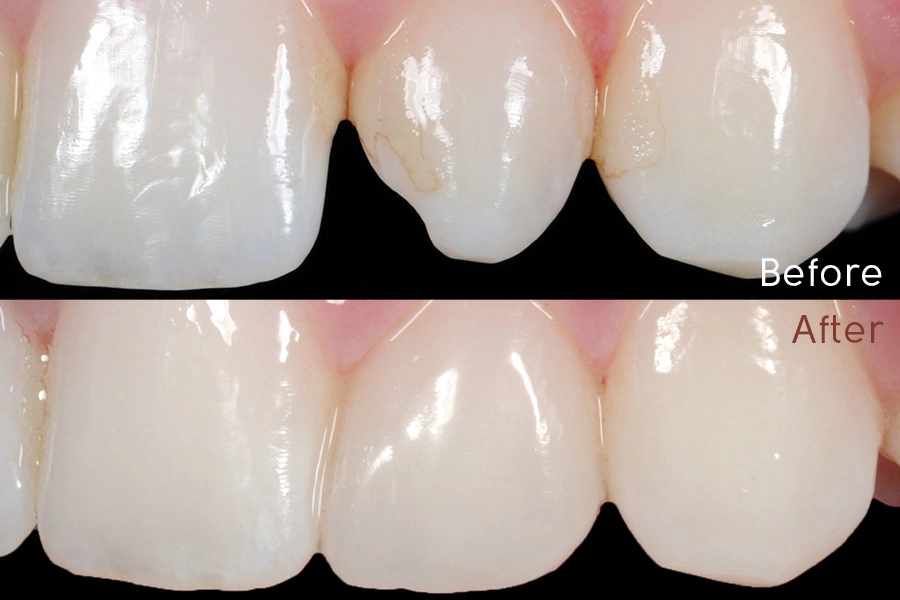 Before-and-after of composite tooth restoration repairing front teeth at Dorri's Dental in Boynton Beach, FL