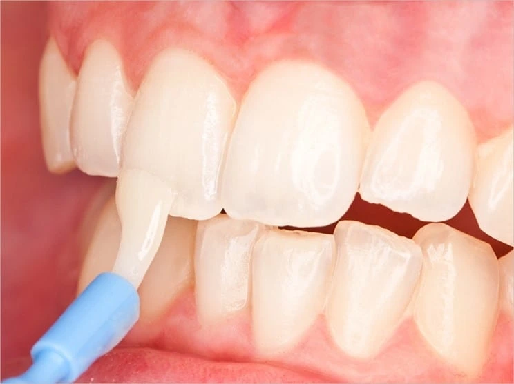 Fluoride varnish being applied to teeth with a brush at Dorri's Dental in Boynton Beach, FL