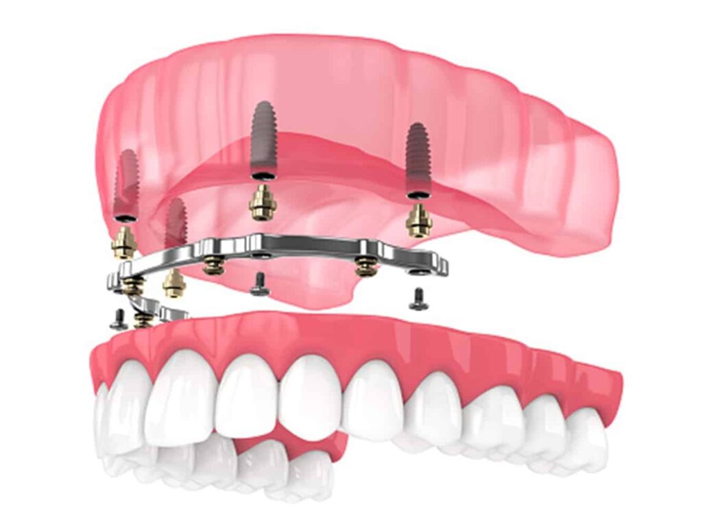 Implant-retained dentures secured with dental implants for a stable and natural-looking smile restoration.