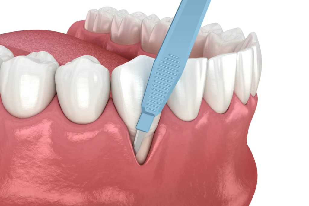 Illustration of periodontal surgery treating advanced gum disease at Dorri's Dental in Boynton Beach, FL