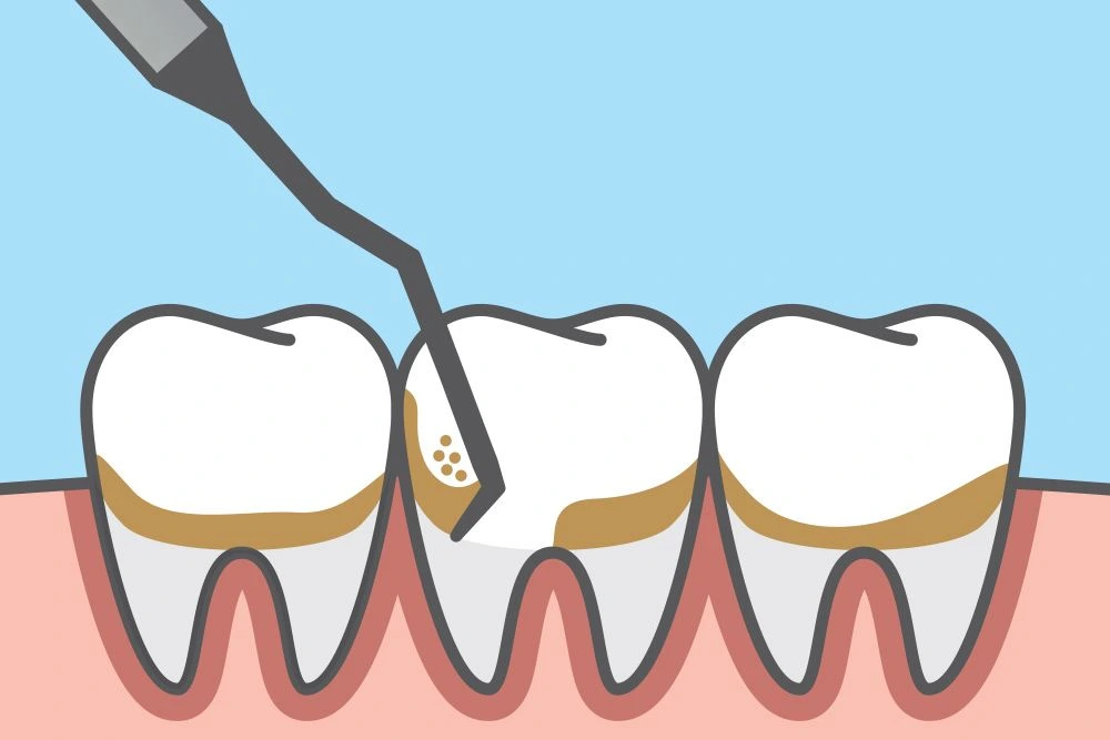 Diagram of a dental tool cleaning below the gum line during scaling and root planing at Dorri's Dental in Boynton Beach, FL