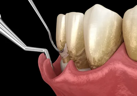 Illustration of periodontal surgery treating diseased gums and tartar buildup at Dorri's Dental in Boynton Beach, FL