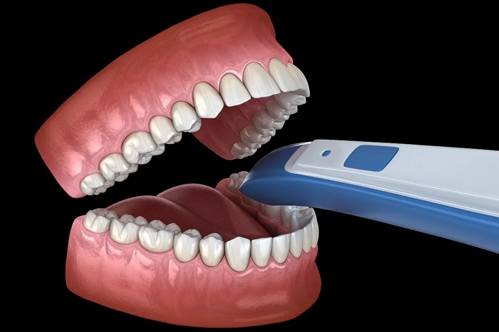 Illustration of an intraoral camera scanning the teeth and gums at Dorri's Dental in Boynton Beach, FL