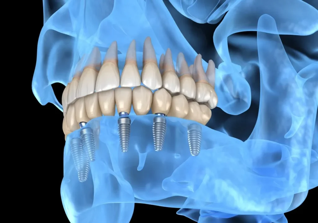 3D CBCT scan illustration showing dental implants in the jawbone at Dorri's Dental in Boynton Beach, FL