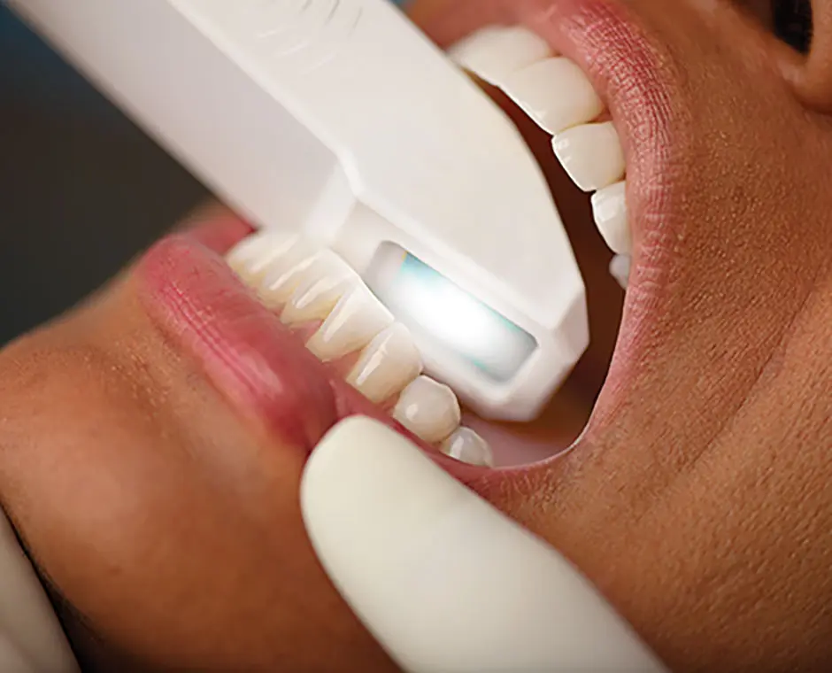 Close-up of an intraoral camera capturing images inside a patient's mouth at Dorri's Dental in Boynton Beach, FL