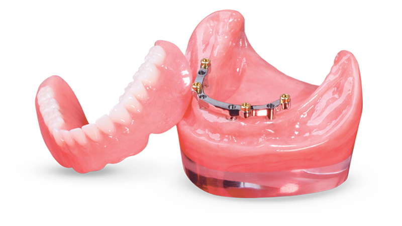 CAD/CAM milled bar overdenture supported by dental implants for enhanced stability and comfort.