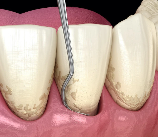 Illustration of scaling and root planing removing plaque below the gum line at Dorri's Dental in Boynton Beach, FL