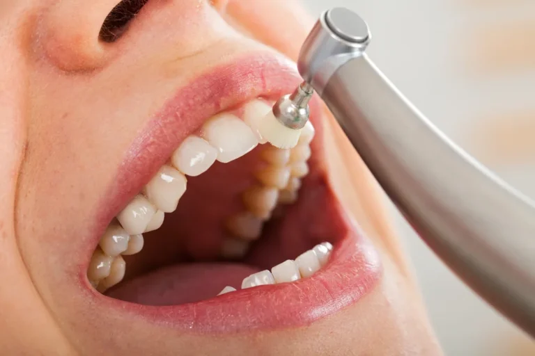 Dentist applying professional fluoride treatment to a patient's teeth at Dorri's Dental in Boynton Beach, FL
