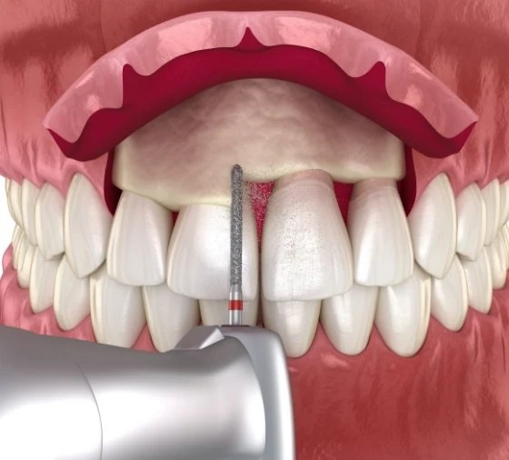 Illustration of a periodontal surgery procedure on the gums at Dorri's Dental in Boynton Beach, FL