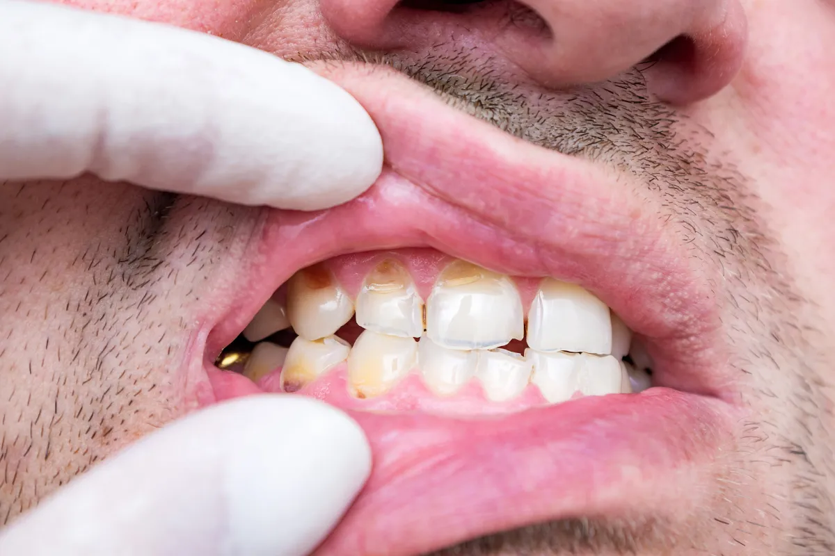 Chipped tooth being examined by a dentist