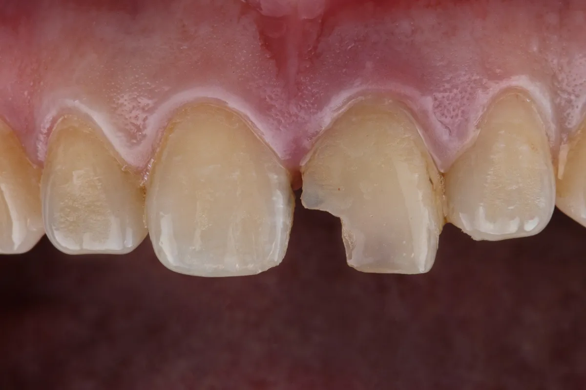 Examples of foods that can chip your teeth