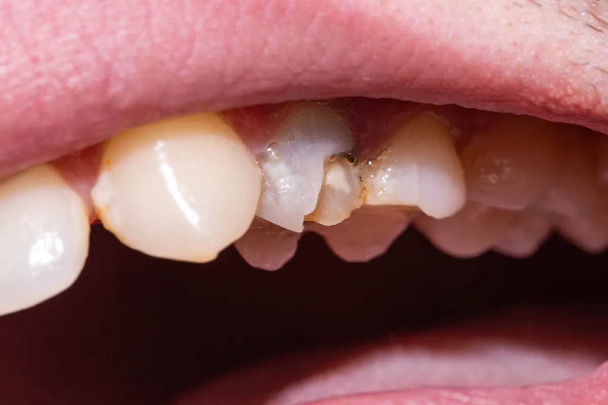 Dental repair options table