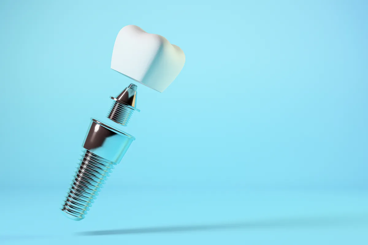 Dental implant vs bridge